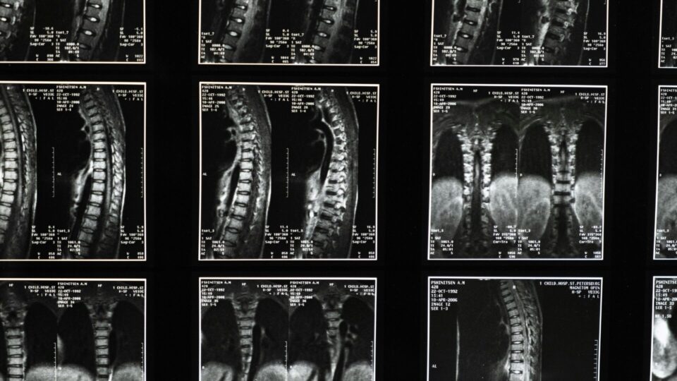 Israel fará primeiro transplante de medula espinhal do mundo e espera que pacientes voltem a andar