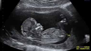 Eugenia? Empresa permite que pais selecionem embriões por QI 1 CRL Crown rump length 12 weeks ecografia Dr. Wolfgang Moroder