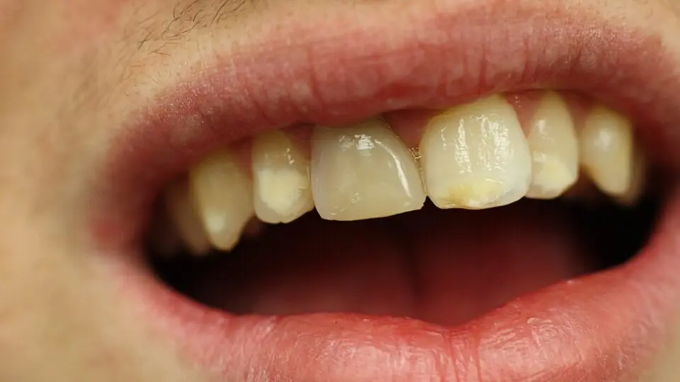 descoberta dentes ossos