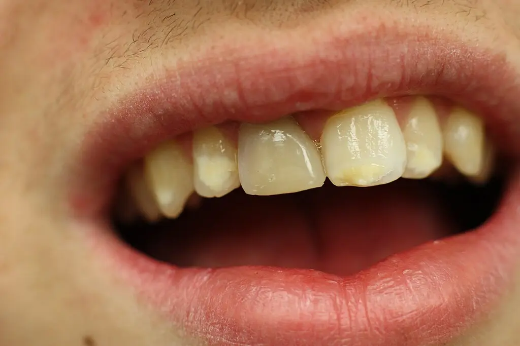 descoberta dentes ossos