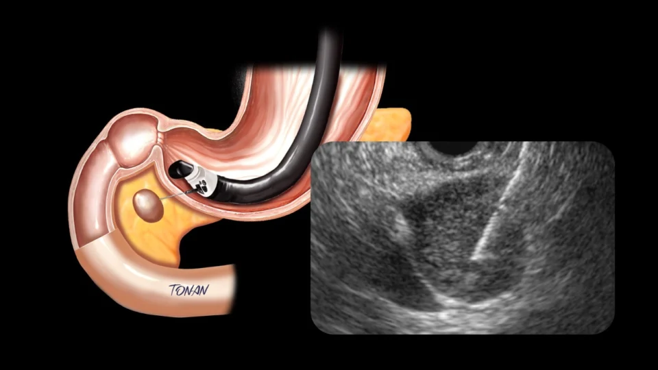 Biópsia no pâncreas por ecoendoscopia. Aqui um endoscópio especial (chamado de encoendoscópio) é inserido através da boca até o estômago. Uma agulha atravessa a parede gastrointestinal até o alvo (tumor no pâncreas).
