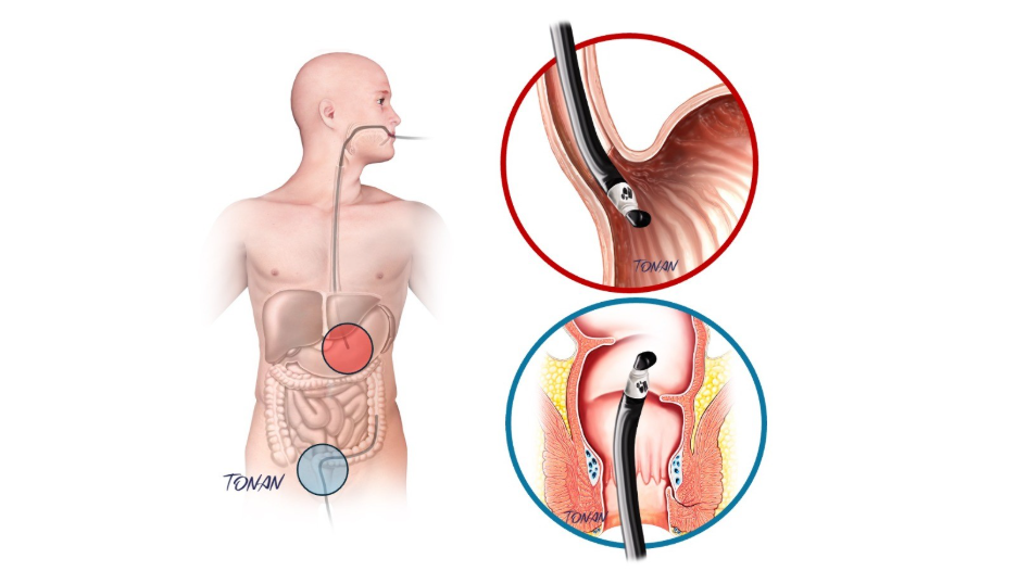 Ecoendoscopia alta e baixa: o exame pode ser realizado por via oral (alta) ou via anal (baixa), permitindo avaliar com precisão diferentes regiões do trato gastrointestinal e orientar o diagnóstico de forma mais completa.