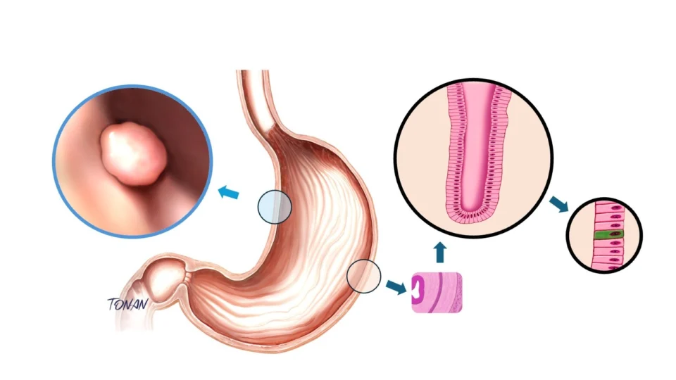 Destaque à direita - representação simplificada de uma célula neuroendócrina situada na parede gástrica. Destaque à esquerda - tumor neuroendócrino em parede gástrica (g-NET).