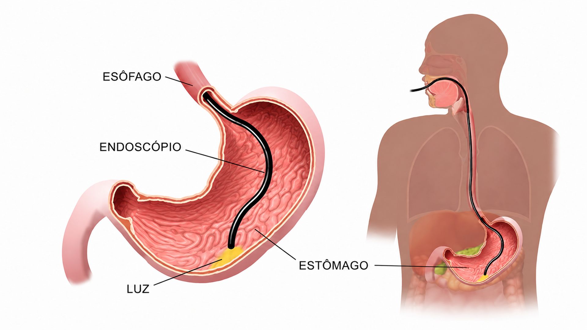 A endoscopia com biópsia é fundamental para identificar tumores neuroendócrinos gástricos e definir o tratamento adequado.