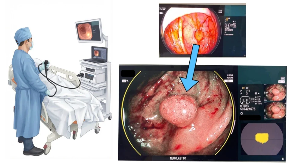 Exame de endoscopia com inteligência artificial. O exame é realizado pelo médico com auxílio de uma processadora que aponta alterações no monitor do equipamento de endoscopia. Seta azul - monitor do equipamento de endoscopia mostrando alteração apontada por inteligência artificial durante exame de colonoscopia (imagem real de um pólipo).