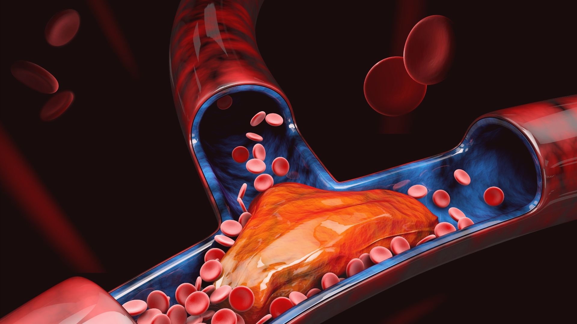 Nova classificação dá conta de cacracterística hipercoagulatória da Covid-19.