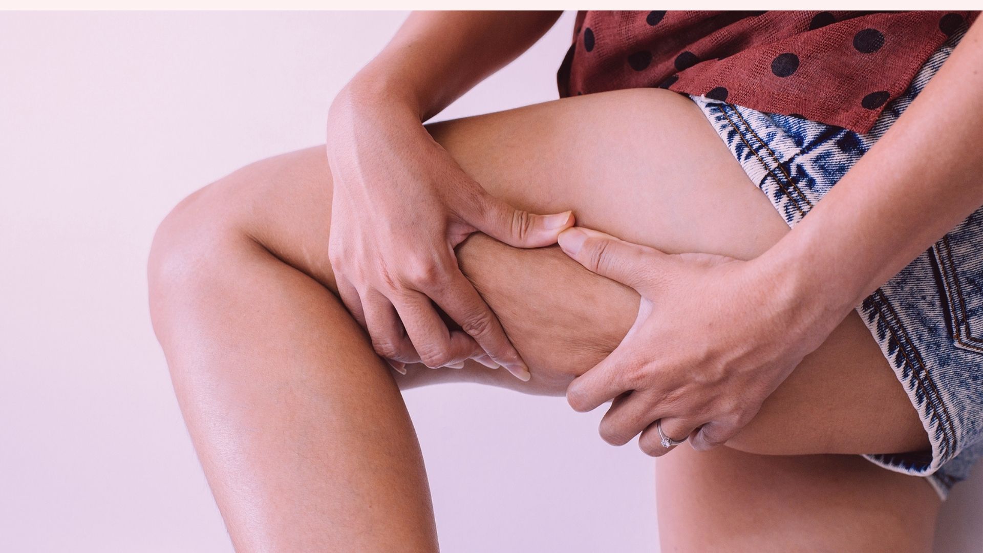 Confundida com obesidade e linfedema, o lipedema costuma engordar mais membros inferiores.