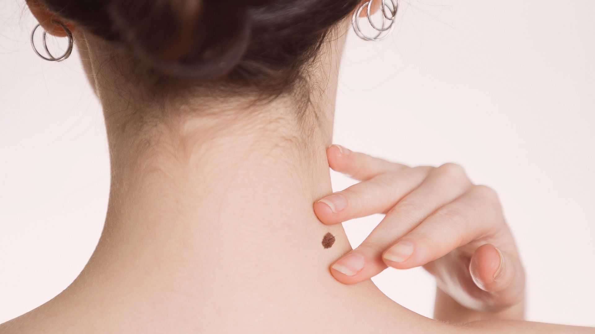 É preciso estar atento às bolinhas que parecem inofensivas, que têm bordas irregulares, coloração múltipla ou pareçam feridas.