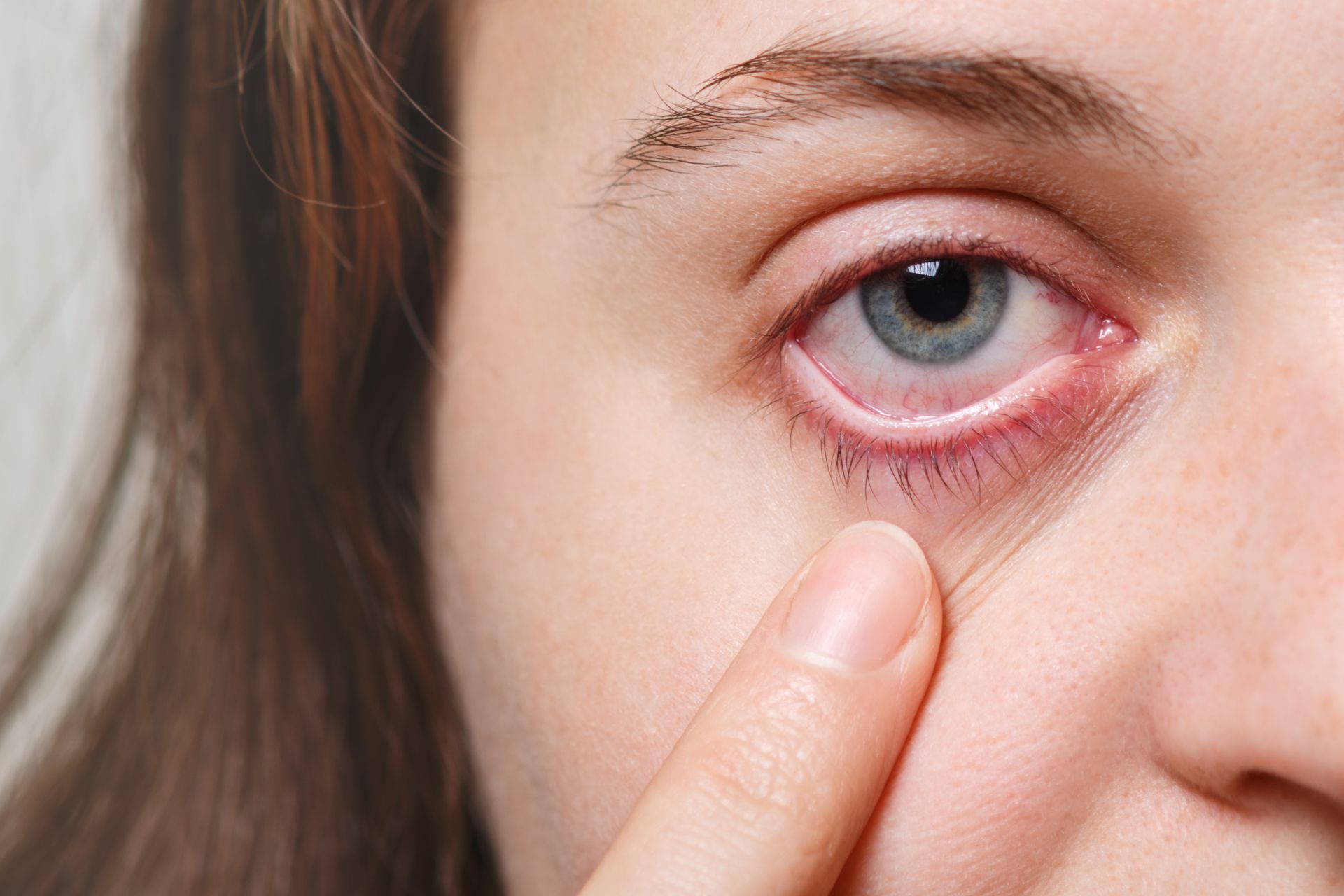 Conjuntivite pode ser bacteriana, viral ou alérgica. (Foto: Bigstock) Conjuntivite pode ser bacteriana, viral ou alérgica. (Foto: Bigstock)
