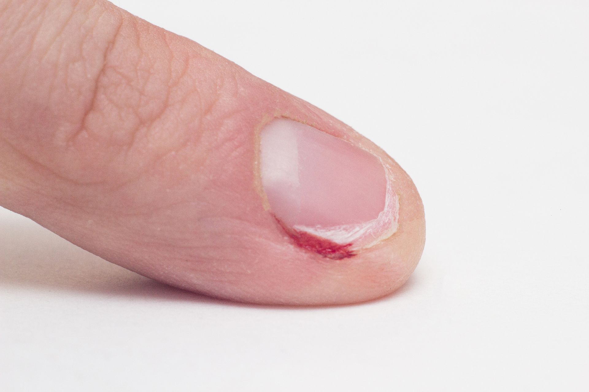 Finger with gnawed nail and cuticle with blood, macro, white background, habit, medical Finger with gnawed nail and cuticle with blood, macro, white background, habit, medical
