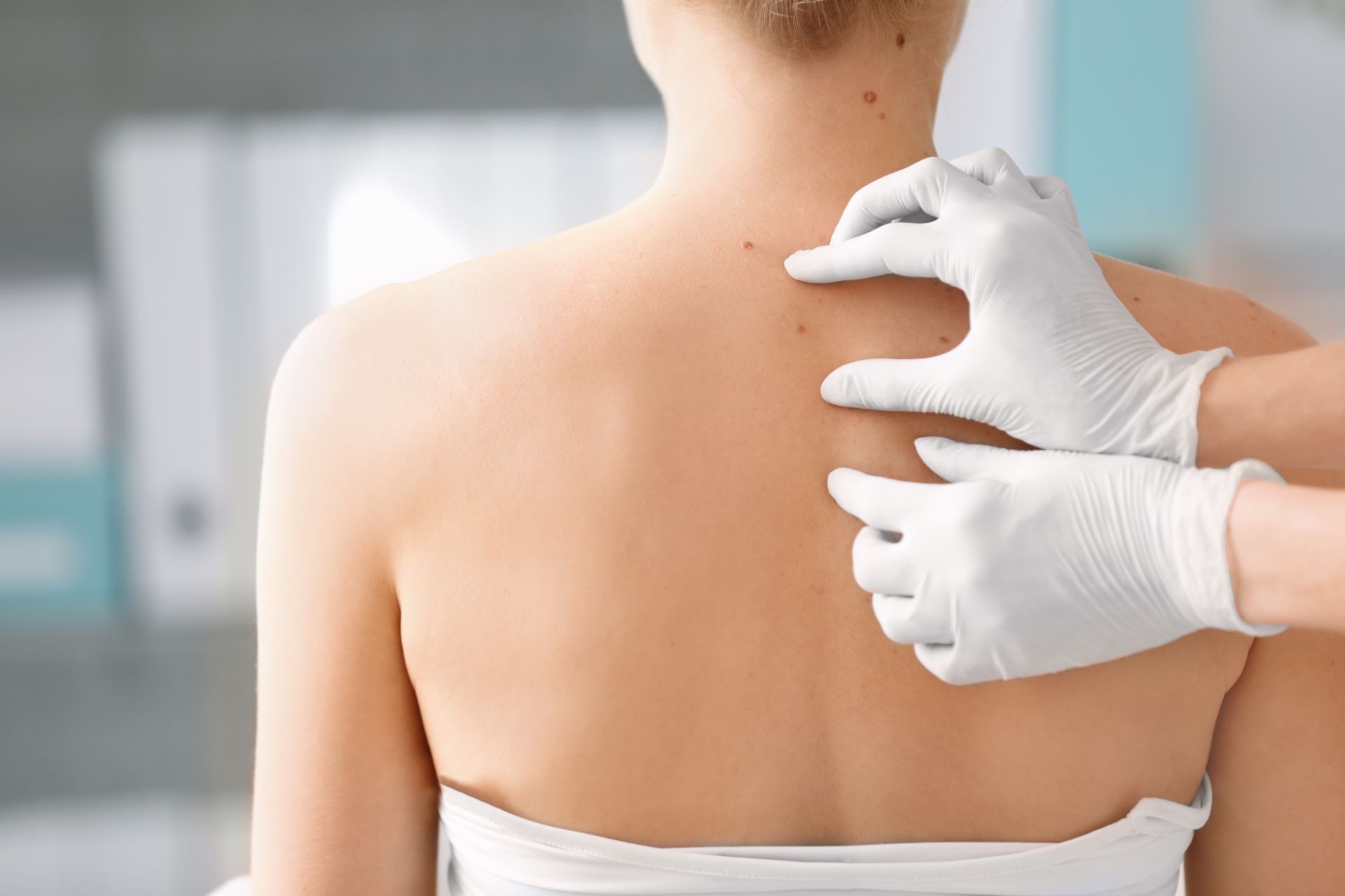 Estudo dinamarquês mostrou uma associação entre pessoas que consumiam um remédio contra pressão alta e o desenvolvimento do câncer de pele não-melanoma (Foto: Bigstock) Estudo dinamarquês mostrou uma associação entre pessoas que consumiam um remédio contra pressão alta e o desenvolvimento do câncer de pele não-melanoma (Foto: Bigstock)