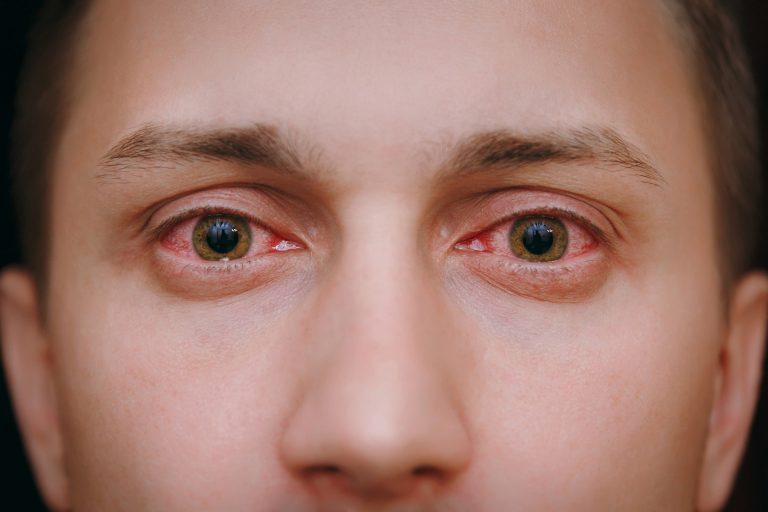 Viral, bacteriana ou alérgica: tratamento e tempo de duração depende do agente infeccioso. Foto: Bigstock.
