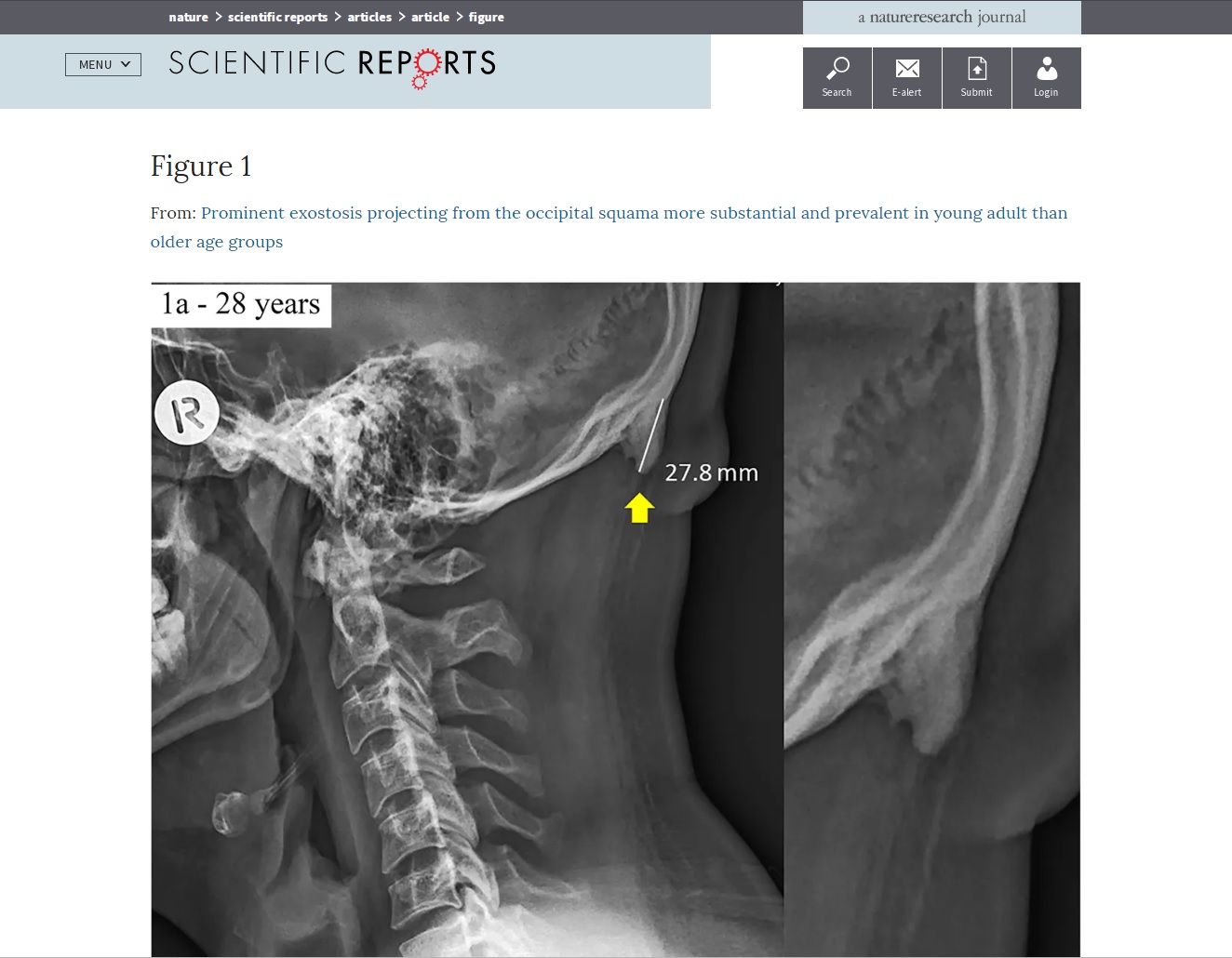 Uso exagerado de smartphones e tablets pode estar relacionado ao surgimento de calcificações na base do crânio de jovens (Foto: reprodução do site da Nature, revista cientifica). Uso exagerado de smartphones e tablets pode estar relacionado ao surgimento de calcificações na base do crânio de jovens (Foto: reprodução do site da Nature, revista cientifica).