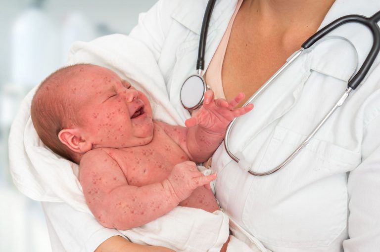 Volta do sarampo alerta para o risco de outra doença, a rubéola, protegida pelas mesmas vacinas. Foto: Bigstock.