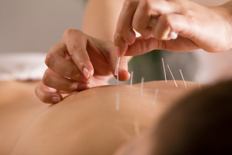 A acupuntura é um dos 29 procedimentos disponíveis à população no Sistema Único de Saúde (SUS).