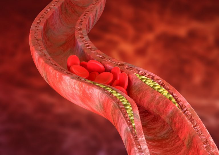 A nova abordagem de detecção de aterosclerose usa como marcadores os anticorpos que são produzidos pelo organismo para combater algumas das toxinas liberadas durante a formação das placas de ateroma. Imagem: Bigstock.