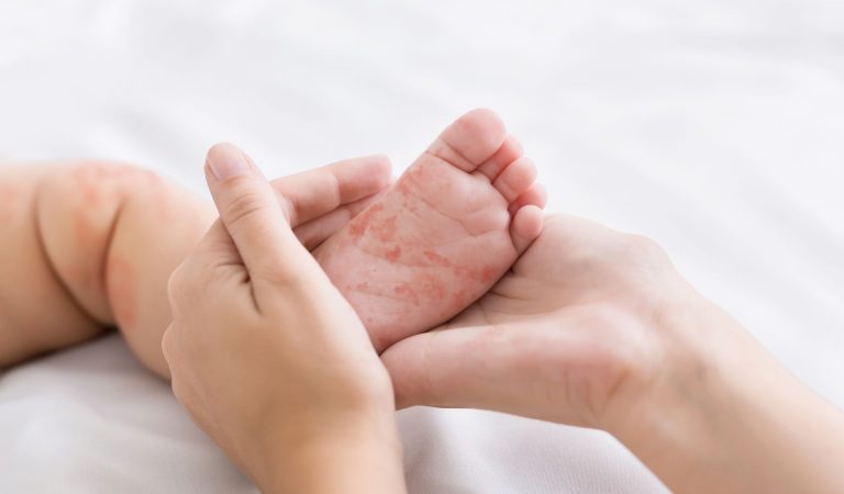 Pegar sarampo faz com que a imunidade também caia em relação a outras doenças. Foto: Bigstock.