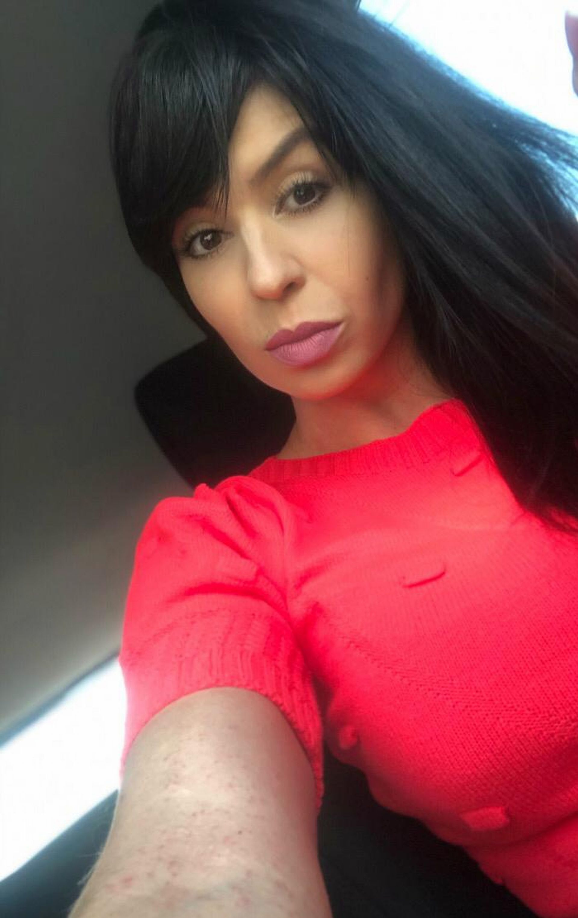Aos 34 anos, depois de viajar a São Paulo, a publicitária Anne Matoso descobriu que estava infectada com sarampo. Na imagem, as manchas já começaram a secar Foto: Arquivo Pessoal Aos 34 anos, depois de viajar a São Paulo, a publicitária Anne Matoso descobriu que estava infectada com sarampo. Na imagem, as manchas já começaram a secar Foto: Arquivo Pessoal