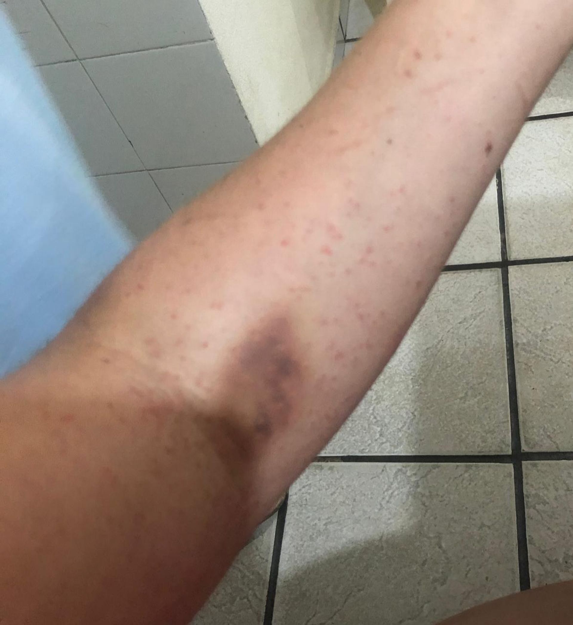 As manchas de sarampo são diferentes das que aparecem na catapora ou varicela; Na imagem, As marcas no braço da publicitária Foto: Arquivo pessoal As manchas de sarampo são diferentes das que aparecem na catapora ou varicela; Na imagem, As marcas no braço da publicitária Foto: Arquivo pessoal