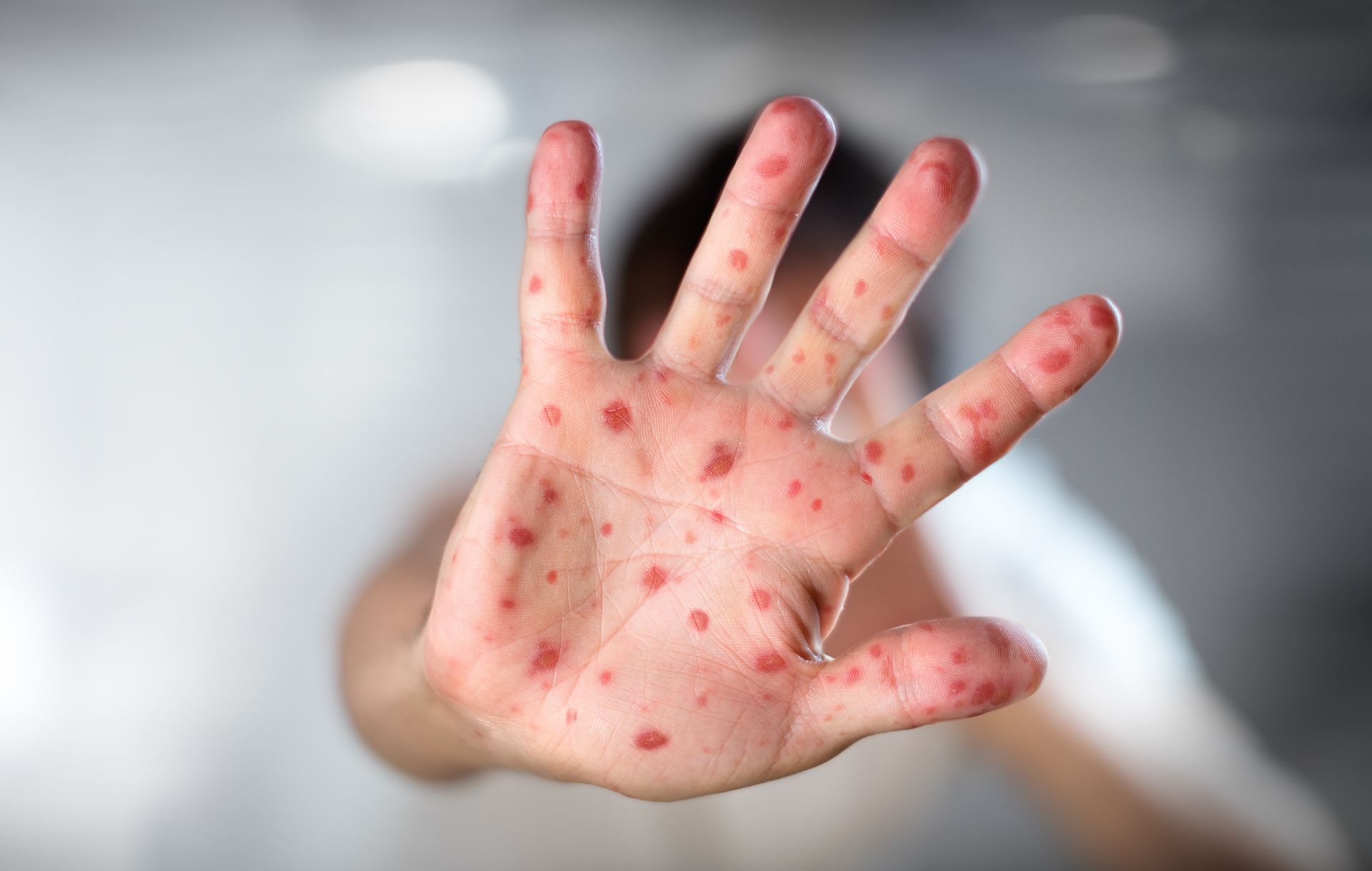 Nos últimos 90 dias de surto ativo, essa faixa etária foi a mais acometida pela doença, com 1.729 casos, concentrando 30,6% das confirmações. Foto: Bigstock.